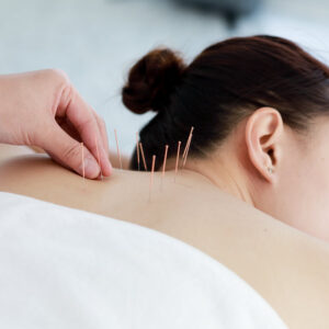 Close up of acupuncture needles placed in back